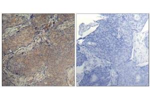 Immunohistochemical analysis of paraffin-embedded human breast carcinoma tissue using Myosin Light Chain 2 (Phospho-Ser19) Antibody (left) or the same antibody preincubated with blocking peptide (right). (MYL9 antibody  (pSer19))
