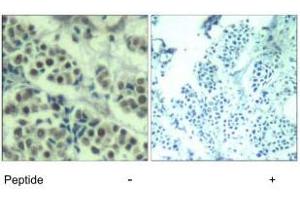 Immunohistochemical analysis of paraffin-embedded human breast carcinoma tissue using MDM2 polyclonal antibody . (MDM2 antibody  (Ser166))