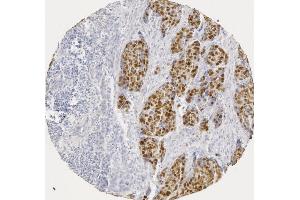 p53 staining in human squamous cell carcinoma (image courtesy of J. (p53 antibody  (AA 20-31))
