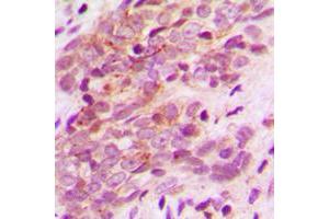 Immunohistochemical analysis of MAGEA9 staining in human breast cancer formalin fixed paraffin embedded tissue section. (MAGEA9 antibody  (N-Term))