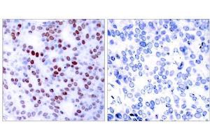 Immunohistochemical analysis of paraffin-embedded human breast carcinoma tissue using c-Jun (Ab-243) antibody (E021025). (C-JUN antibody)