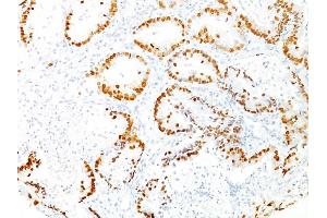 Formalin-fixed, paraffin-embedded human Lung Adenocarcinoma stained with TTF-1 Mouse Monoclonal Antibody (8G7G3/1). (NKX2-1 antibody)
