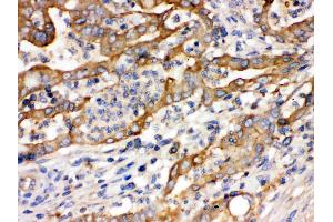Alpha Actinin 4 was detected in paraffin-embedded sections of human intestinal  cancer tissues using rabbit anti- Alpha Actinin 4 Antigen Affinity purified polyclonal antibody (Catalog # ) at 1 µg/mL. (alpha Actinin 4 antibody  (AA 561-661))