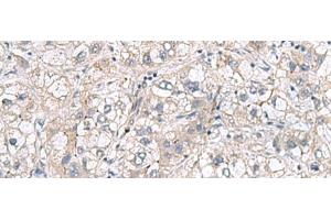 Immunohistochemistry of paraffin-embedded Human liver cancer tissue using RNF208 Polyclonal Antibody at dilution of 1:65(x200) (RNF208 antibody)