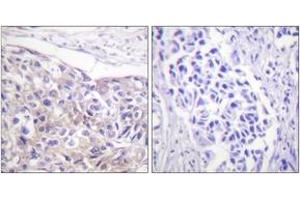 Immunohistochemistry analysis of paraffin-embedded human breast carcinoma, using p90 RSK (Phospho-Thr573) Antibody. (RPS6KA3 antibody  (pThr573))
