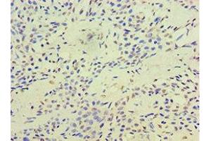 Immunohistochemistry of paraffin-embedded human breast cancer using ABIN7171737 at dilution of 1:100 (RAP1 antibody  (AA 1-280))