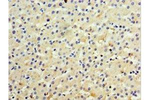 Immunohistochemistry of paraffin-embedded human liver cancer using ABIN7156612 at dilution of 1:100 (IL28B antibody  (AA 22-196))