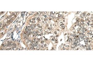 Immunohistochemistry of paraffin-embedded Human gastric cancer tissue using MCPH1 Polyclonal Antibody at dilution of 1:110(x200) (MCPH1 antibody)