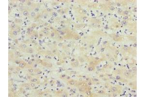 Immunohistochemistry of paraffin-embedded human liver cancer using ABIN7145848 at dilution of 1:100 (KCTD19 antibody  (AA 490-751))