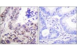 Immunohistochemistry analysis of paraffin-embedded human colon carcinoma, using Caspase 9 (Phospho-Ser144) Antibody.