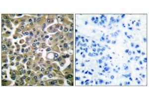 Immunohistochemical analysis of paraffin-embedded human breast carcinoma tissue using Keratin 16 antibody (ABIN5976436).