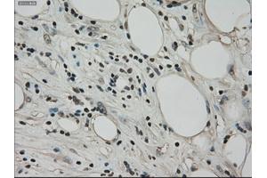 Immunohistochemical staining of paraffin-embedded Adenocarcinoma of ovary tissue using anti-BUB1Bmouse monoclonal antibody. (BUB1B antibody)
