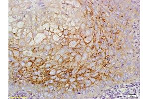 Formalin-fixed and paraffin embedded human laryngeal cancer labeled with Anti-CD44v5 Polyclonal Antibody, Unconjugated  at 1:200 followed by conjugation to the secondary antibody (CD44RC (AA 61-139) antibody)