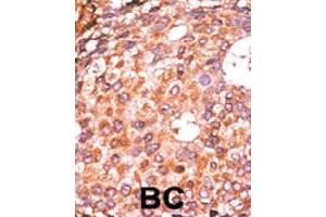 Formalin-fixed and paraffin-embedded human cancer tissue reacted with E2F1 (phospho S337) polyclonal antibody  which was peroxidase-conjugated to the secondary antibody followed by AEC staining.