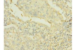 Immunohistochemistry of paraffin-embedded human lung cancer using ABIN7167504 at dilution of 1:100 (PTPRJ antibody  (AA 140-370))