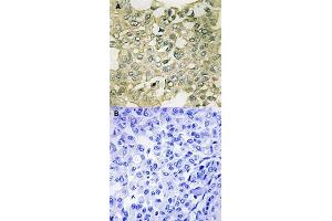 Immunohistochemical staining of human breast carcinoma tissue by PKMYT1 (phospho S83) polyclonal antibody  without blocking peptide (A) or preincubated with blocking peptide (B) under 1:50-1:100 dilution. (PKMYT1 antibody  (pSer83))