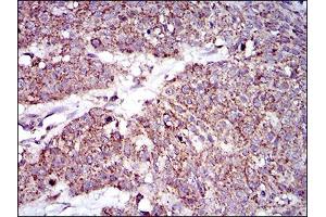 Immunohistochemical analysis of paraffin-embedded esophageal cancer tissues using MRPL42 mouse mAb with DAB staining. (MRPL42 antibody  (AA 142-203))