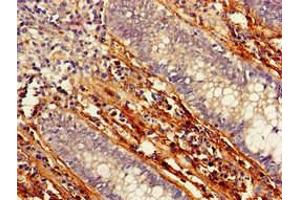 Immunohistochemistry of paraffin-embedded human colon cancer using ABIN7165903 at dilution of 1:100 (Patched 1 antibody  (AA 1180-1411))