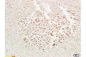 Formalin-fixed and paraffin embedded mouse tumor tissue labeled with Anti-TRAF1 Polyclonal Antibody, Unconjugated (ABIN673464) at 1:200 followed by conjugation to the secondary antibody and DAB staining. (TRAF1 antibody  (AA 301-416))