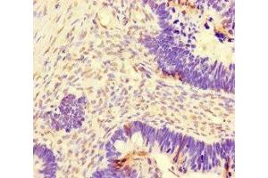 Immunohistochemistry of paraffin-embedded human ovarian cancer using ABIN7150550 at dilution of 1:100 (DNAJC3 antibody  (AA 277-496))