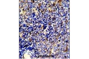 Formalin-fixed and paraffin-embedded human lymphoma reacted with MERTK Antibody, which was peroxidase-conjugated to the secondary antibody, followed by DAB staining.