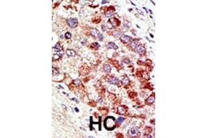 Formalin-fixed and paraffin-embedded human cancer tissue reacted with the primary antibody, which was peroxidase-conjugated to the secondary antibody, followed by AEC staining. (CBLC antibody  (N-Term))