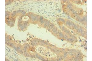 Immunohistochemistry of paraffin-embedded human colon cancer using ABIN7162499 at dilution of 1:100 (PAX4 antibody  (AA 50-200))