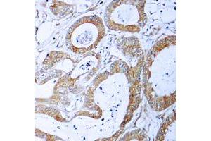 Immunohistochemical analysis of TRADD staining in human colon cancer formalin fixed paraffin embedded tissue section. (TRADD antibody  (C-Term))