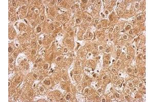 IHC-P Image AMPK gamma 2 antibody [C2C3], C-term detects PRKAG2 protein at nucleus and cytosol human on hepatoma by immunohistochemical analysis. (PRKAG2 antibody  (C-Term))