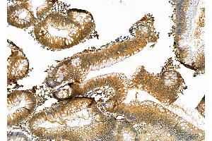 ABIN6264411 and ABIN6276954 at 1/100 staining Human colorectal cancer by IHC-P.