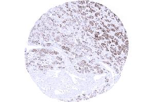 Kidney Clear cell renal cell carcinoma showing moderate to strong Melan A immunostaining of tumor cells (Recombinant MLANA antibody)