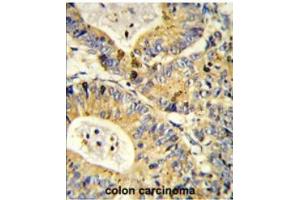 Formalin-fixed and paraffin-embedded human colon carcinoma reacted with RS18 Antibody (Center) followed which was peroxidase-conjugated to the secondary antibody, followed by DAB staining. (RPS18 antibody  (Middle Region))