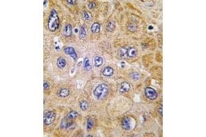 Formalin-fixed and paraffin-embedded human hepatocarcinoma tissue reacted with THY1 antibody , which was peroxidase-conjugated to the secondary antibody, followed by DAB staining. (CD90 antibody  (N-Term))