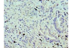 Immunohistochemistry of paraffin-embedded human lung cancer using ABIN7174459 at dilution of 1:100 (UBE2J2 antibody  (AA 1-230))