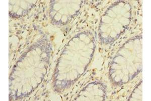Immunohistochemistry of paraffin-embedded human colon cancer using ABIN7147425 at dilution of 1:100 (Cep76 antibody  (AA 241-550))