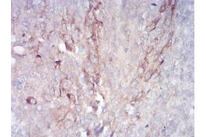 Immunohistochemical analysis of paraffin-embedded bladder cancer tissues using RAB11FIP1 mouse mAb with DAB staining. (RAB11FIP1 antibody  (AA 130-271))