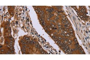 Immunohistochemistry of paraffin-embedded Human colon cancer using Catenin gamma Polyclonal Antibody at dilution of 1:40 (JUP antibody)