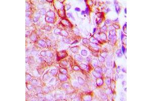 Immunohistochemical analysis of LPHN2 staining in human breast cancer formalin fixed paraffin embedded tissue section. (LPHN2 antibody  (Center))