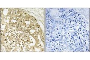Immunohistochemistry analysis of paraffin-embedded human breast carcinoma tissue, using Catenin-beta (Ab-37) Antibody. (beta Catenin antibody  (AA 3-52))