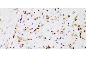 Immunohistochemistry of paraffin-embedded Human liver cancer using IKK beta Polyclonal Antibody at dilution of 1:100 (40x lens).