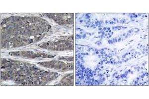 Immunohistochemistry analysis of paraffin-embedded human breast carcinoma tissue, using NF-kappaB p105/p50 (Ab-932) Antibody. (NFKB1 antibody  (AA 899-948))