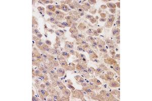(ABIN6242760 and ABIN6577246) staining AFP in human liver tissue sections by Immunohistochemistry (IHC-P - paraformaldehyde-fixed, paraffin-embedded sections). (alpha Fetoprotein antibody  (AA 281-609))