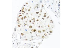 Immunohistochemistry of paraffin-embedded human lung cancer using THOC1 antibody (ABIN5974800) at dilution of 1/100 (40x lens). (THOC1 antibody)