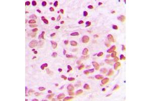 Immunohistochemical analysis of PML staining in human breast cancer formalin fixed paraffin embedded tissue section. (PML antibody  (N-Term))