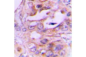 Immunohistochemical analysis of NDRG2 staining in human lung cancer formalin fixed paraffin embedded tissue section. (NDRG2 antibody  (Center))
