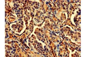 IHC image of ABIN7164696 diluted at 1:200 and staining in paraffin-embedded human lung cancer performed on a Leica BondTM system.