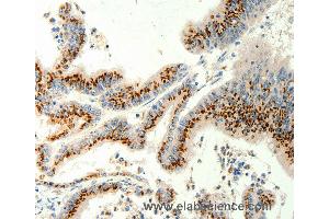 Immunohistochemistry of Human gastric cancer using TRPC6 Polyclonal Antibody at dilution of 1:40