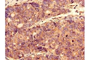 Immunocytochemistry analysis of human gastric cancer using ABIN7148718 at dilution of 1:100