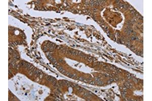 The image on the left is immunohistochemistry of paraffin-embedded Human colon cancer tissue using ABIN7191233(KLRF1 Antibody) at dilution 1/30, on the right is treated with synthetic peptide. (KLRF1 antibody)