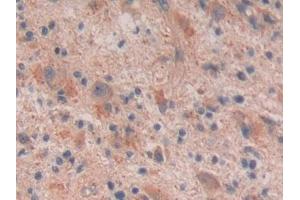DAB staining on IHC-P; Samples: Human Glioma Tissue (Reelin antibody  (AA 26-190))